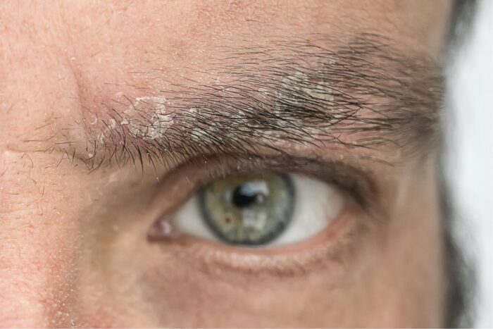 What to do in case of eyebrow dandruff?