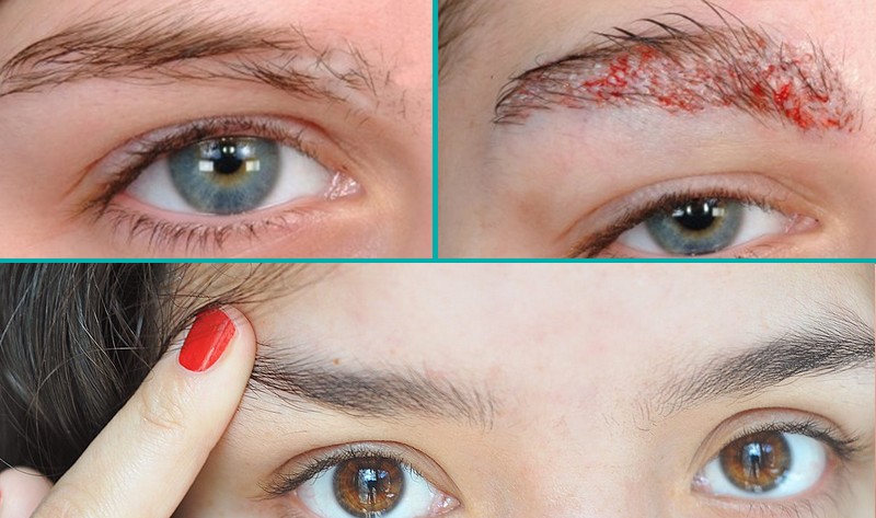 Why Itchy Eyebrows Causes And Treatment Solved 2022