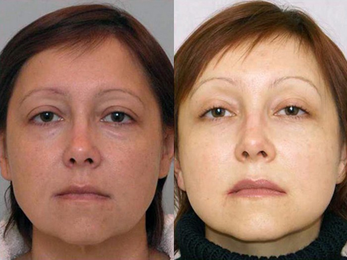 Brow lift with botox before and after photos