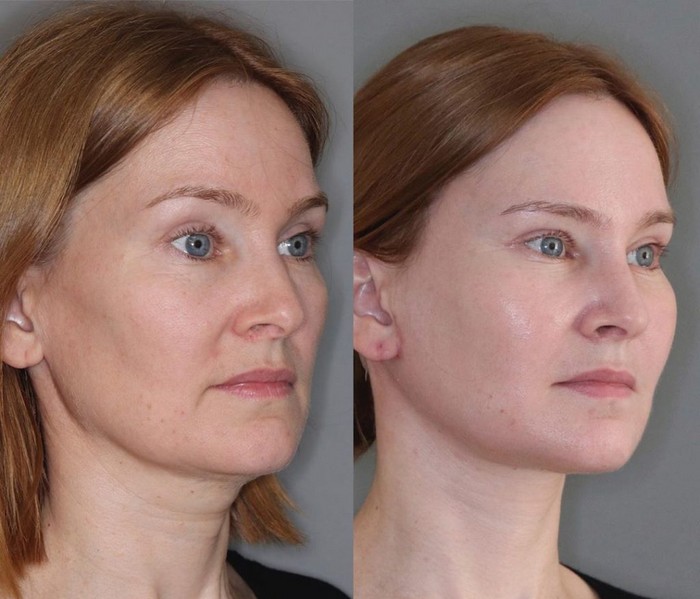 Brow lift with botox before and after photos