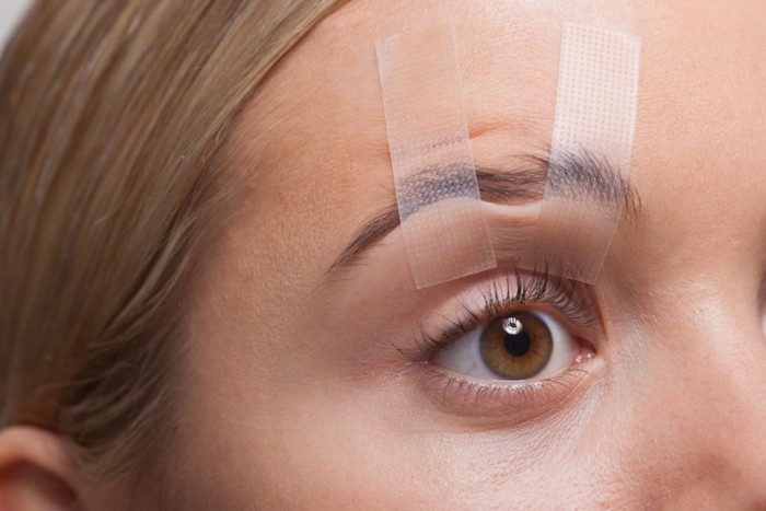 How long does it take to fully recover after a brow lift