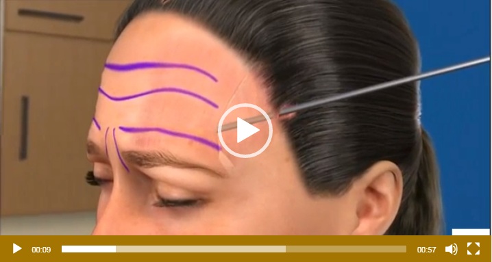 surgical brow lift
