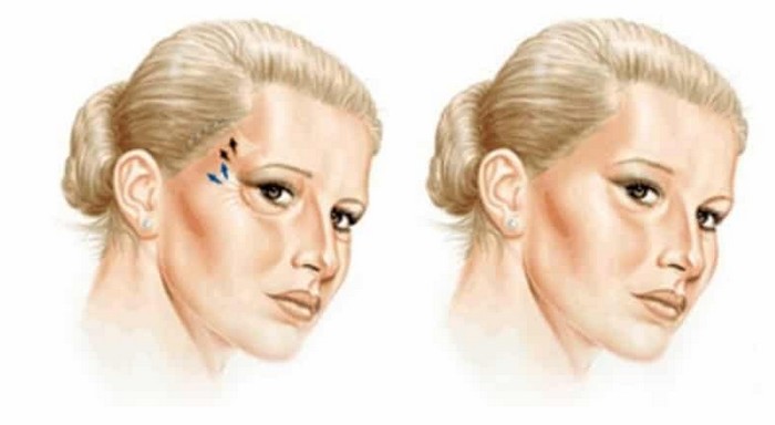 temporal brow lift