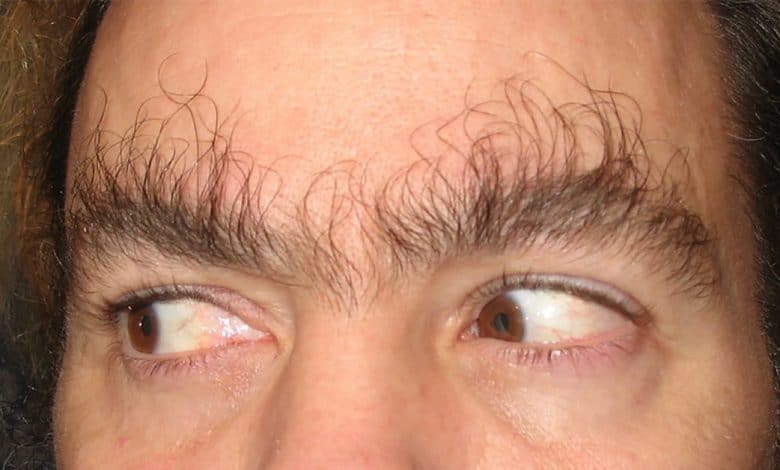 What Causes Random Long Eyebrow Hair 